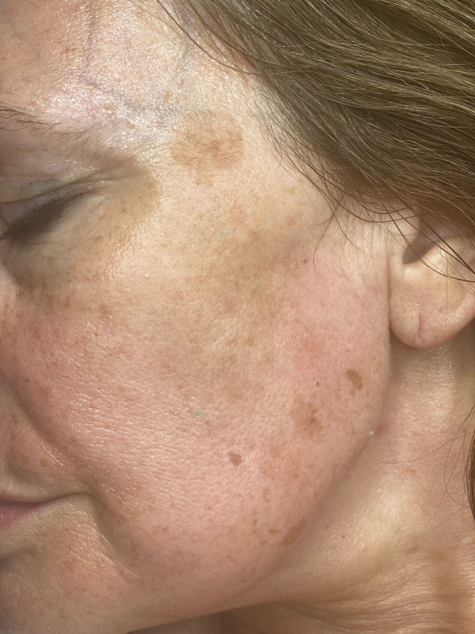 What Are Sunspots on the Skin and How Should I Treat Them?