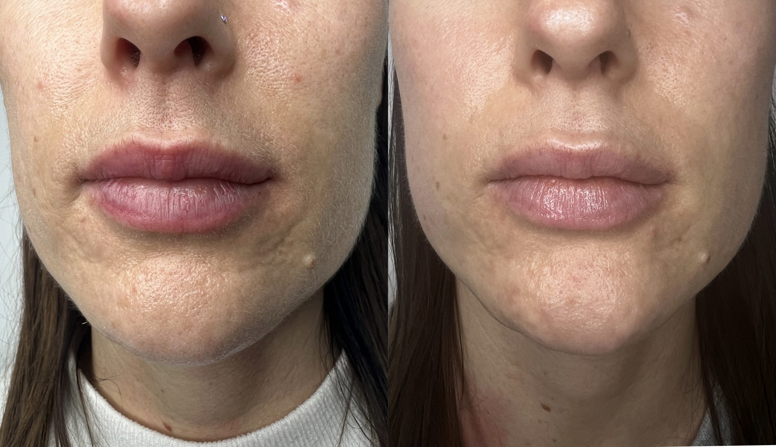 CO2 Laser Resurfacing Before & After Pictures