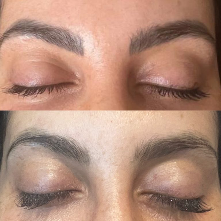 Laser semi-permanent eyebrow removal results