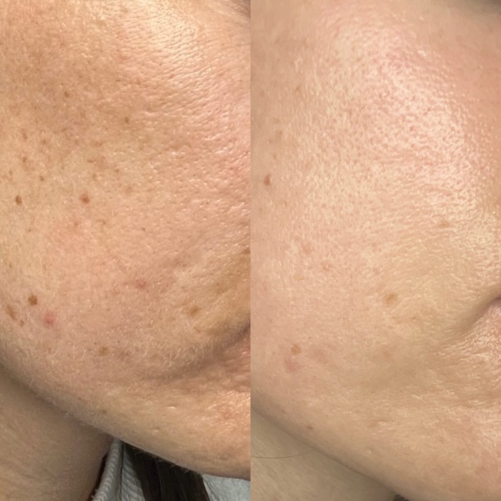 CO2 scar removal 1