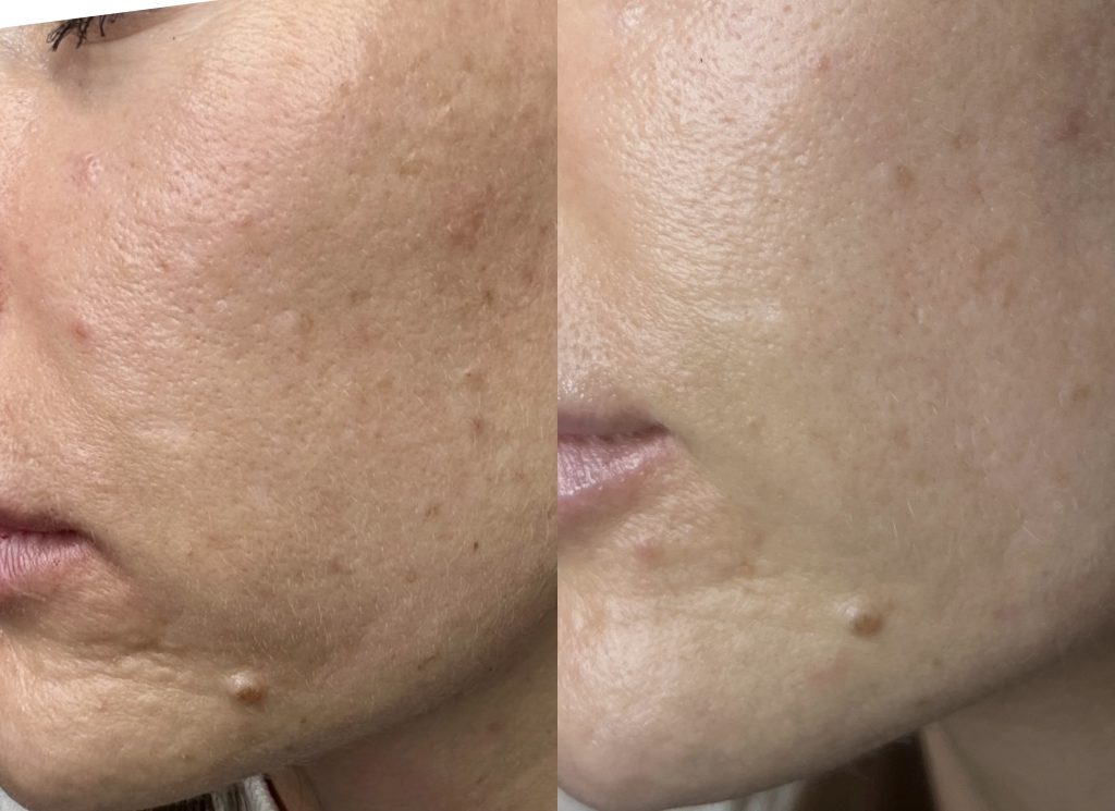 CO2 scar removal 2