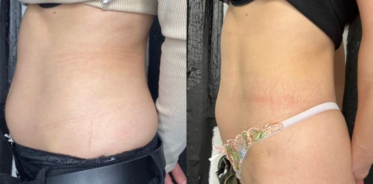 side by side showing the before and after of a Cryolipolysis