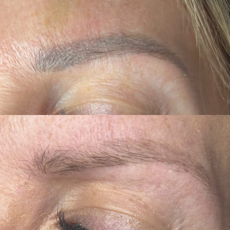 Laser tattoo removal eyebrow before and after 1